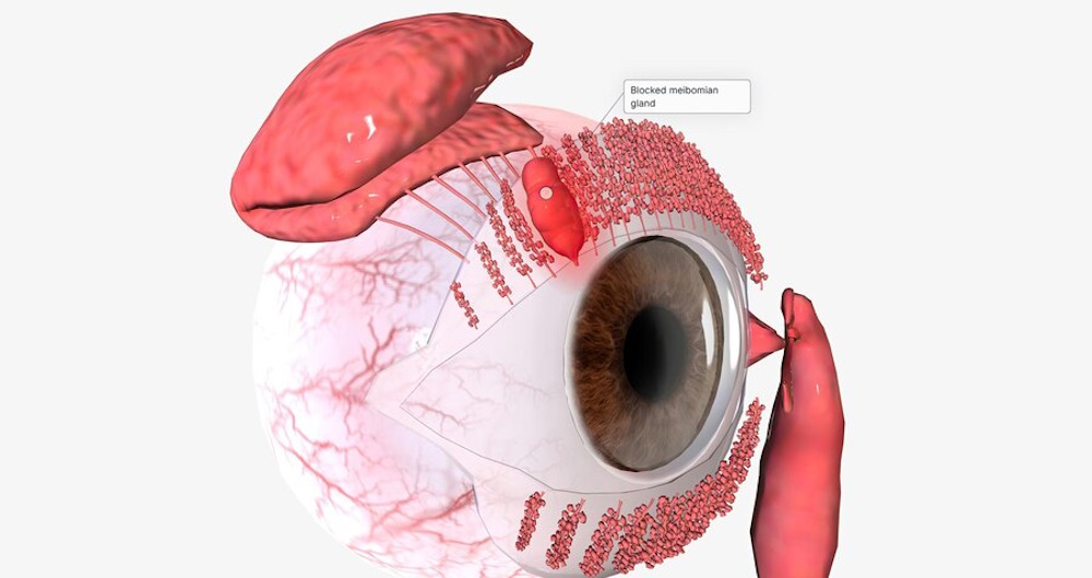 simptomy-khalyaziona-na-veke.jpg