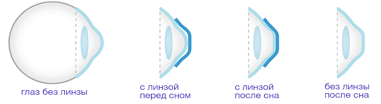 Схематическое изображение линзы до и после сна, как работают ночные ортокератологические линзы