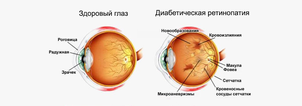 Диабетическая ретинопатия: болезни в офтальмологии