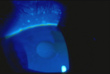 Дистрофия базальной эпителиальной мембраны (флюоресцеин) 