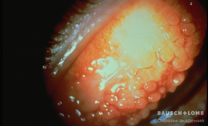 Гигантский папиллярный конъюнктивит 